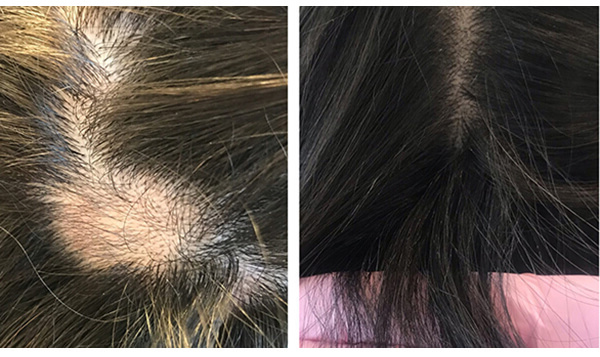 Мезококтейль против выпадения волос и стимуляции их ростаMESO HAIR LOSS CONTROL+